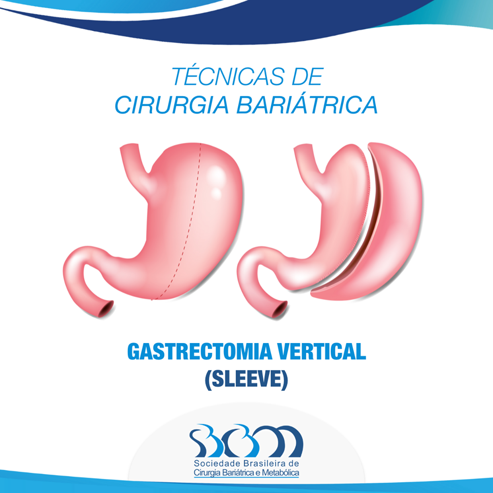 Técnicas de Cirurgia Bariátrica - Gastrectomia Vertical (Sleeve) - Clínica Katayama e Tamasauskas